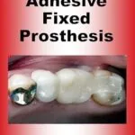 خرید و دانلود نسخه کامل کتاب Adhesive Fixed Prosthesis