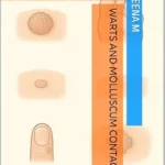 خرید و دانلود نسخه کامل کتاب Warts and Molluscum Contagiosum: A Comprehensive Guide to Homeopathic Treatment”