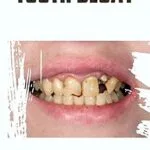 خرید و دانلود نسخه کامل کتاب TOOTH DECAY: Symptoms, Causes, Treatment, and Prevention