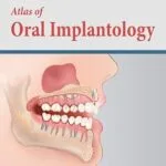 خرید و دانلود نسخه کامل کتاب Atlas of Oral Implantology – E-Book