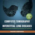خرید و دانلود نسخه کامل کتاب Computed Tomography of Interstitial Lung Diseases [Print Replica] Kindle Edition
