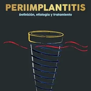 خرید و دانلود نسخه کامل کتاب PERIIMPLANTITIS: Definicion, etiologia y tratamiento (Spanish Edition)