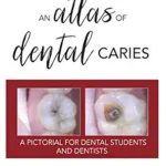 خرید و دانلود نسخه کامل کتاب An Atlas of Dental Caries: A Pictorial For Dental Students and Dentists