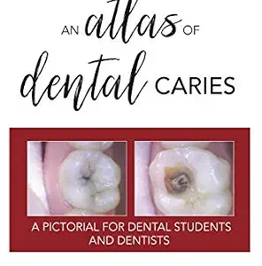 خرید و دانلود نسخه کامل کتاب An Atlas of Dental Caries: A Pictorial For Dental Students and Dentists