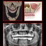 خرید و دانلود نسخه کامل کتاب BASICS OF BASAL AND ZYGOMATIC IMPLANTS