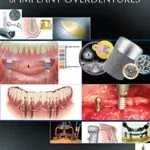 خرید و دانلود نسخه کامل کتاب Clinical and Laboratory Manual of Implant Overdentures 1st Edition