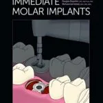 خرید و دانلود نسخه کامل کتاب Immediate Molar Implants Kindle Edition