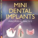 خرید و دانلود نسخه کامل کتاب Mini Dental Implants: Principles and Practices 1st Edition