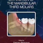 خرید و دانلود نسخه کامل کتاب Transalveolar Extraction of the Mandibular Third Molars